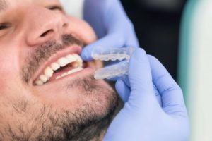 Behandlungsablauf Invisalign© Zahnspange erklärt