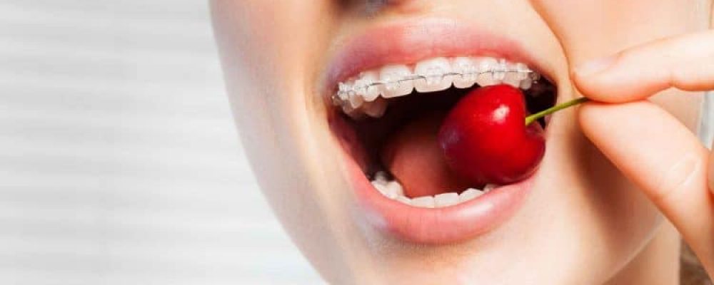 Festsitzende Zahnspange - Alles was Sie über die feste Zahnregulierung wissen sollten.